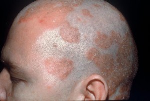 Seboreik Dermatit Tedavi