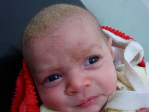 Bebeklerde Seboreik Dermatit